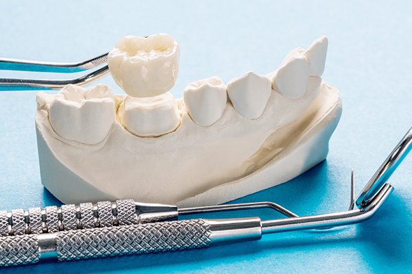 a model of dental crowns and bridges with tools, typical of dental services in Hamilton, Ontario.